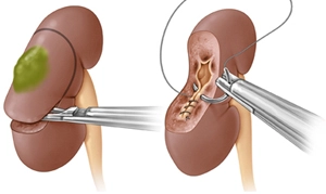 Laparoscopic Kidney Surgeons in Bhopal